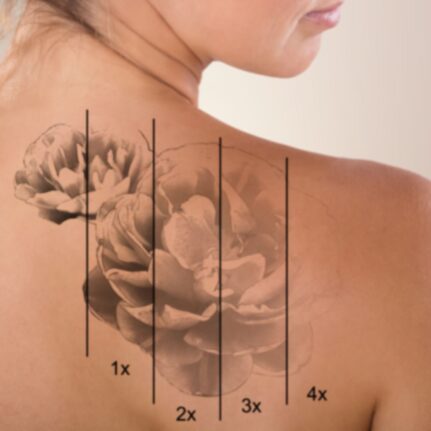 Garai Klaudia - sminktetoválás & tetoválás eltávolítás -LAY Beauty, Vác - Kémiai InSkin és YAG lézeres tetoválás eltávolítás