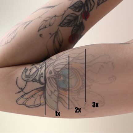 Garai Klaudia - sminktetoválás & tetoválás eltávolítás -LAY Beauty, Vác - Kémiai InSkin és YAG lézeres tetoválás eltávolítás