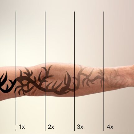 Garai Klaudia - sminktetoválás & tetoválás eltávolítás -LAY Beauty, Vác - Kémiai InSkin és YAG lézeres tetoválás eltávolítás