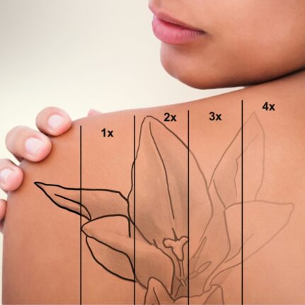 Garai Klaudia - sminktetoválás & tetoválás eltávolítás -LAY Beauty, Vác - Kémiai InSkin és YAG lézeres tetoválás eltávolítás